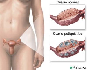 ovarios poliquisticos 